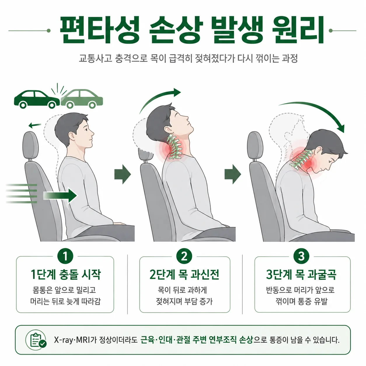 교통사고 편타성 손상 발생 과정 인포그래픽