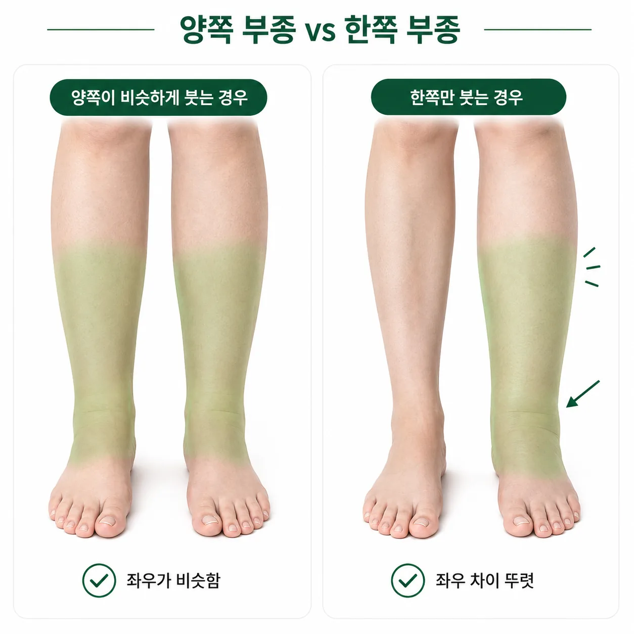 양쪽 부종과 한쪽 부종을 비교한 그림