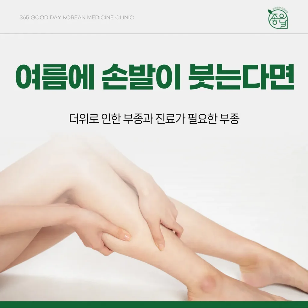 여름에 손발이 붓는다면 — 더위로 인한 부종과 진료가 필요한 부종